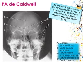 PA de Caldwell Radiografía tomada con una discreta angulación del haz de rayos hacia abajo. Útil para determinar simetría ...
