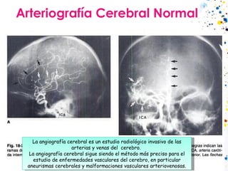 Arteriografía Cerebral Normal La angiografía cerebral es un estudio radiológico invasivo de las arterias y venas del  cere...