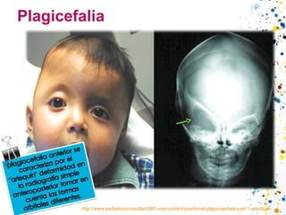 Plagicefalia http://www.pediatricsconsultant360.com/content/positional-plagiocephaly-part-1-practical-guide-evaluation 