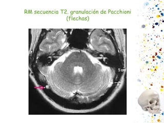 RM secuencia T2. granulación de Pacchioni (flechas) 