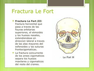 Fractura Le Fort
 Fractura Le Fort III:
fractura horizontal que
pasa a traves de las
fisuras orbitarias
superiores, el etmoides
y los huesos nasales,
extendiendose en
direccion lateral a traves
de las alas mayores del
esfenoides y las suturas
frontocigomaticas.
 La fractura concurrente
de los areos cigomaticos
separa los huesos
maxilares y cigomaticos
del resto del craneo.
 