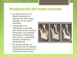 Reabsorción del hueso alveolar
 La extraccion de los
dientes produce la
reabsorcion del hueso
alveolar en la region
afectada.
 Siguiendo a la
extraccion o perdida
com pleta de los huesos
maxilares, los alveolos
empiezan a rellenarse
con hueso y la apoflsis
alveolar empieza a
reabsorberse.
 De forma similar, la
extraccion de los dientes
mandibulares produce la
reabsorcion del hueso.
 