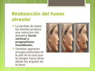 Reabsorción del hueso
alveolar
 La perdida de todos
los dientes produce
una reduccion del
diametro facial
vertical y
prognatismo
mandibular.
 Tambien aparecen
arrugas profundas en
la piel de la cara que
se dirigen hacia atras
desde los angulos de
la boca.
 