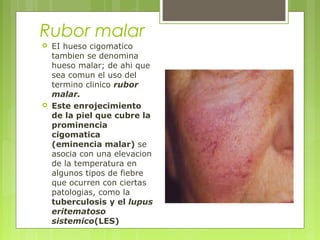 Rubor malar
 EI hueso cigomatico
tambien se denomina
hueso malar; de ahi que
sea comun el uso del
termino clinico rubor
malar.
 Este enrojecimiento
de la piel que cubre la
prominencia
cigomatica
(eminencia malar) se
asocia con una elevacion
de la temperatura en
algunos tipos de fiebre
que ocurren con ciertas
patologias, como la
tuberculosis y el lupus
eritematoso
sistemico(LES)
 