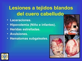 Lesiones a tejidos blandos del cuero cabelludo. Laceraciones. Hipovolemia (Niño e infantes). Heridas estrelladas. Avulsiones. Hematomas subgaleales. 