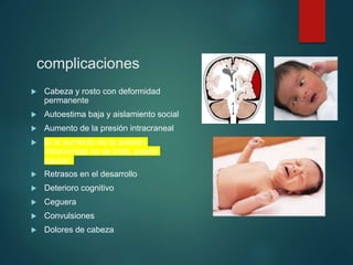 complicaciones
 Cabeza y rosto con deformidad
permanente
 Autoestima baja y aislamiento social
 Aumento de la presión intracraneal
 Si el aumento de la presión
intracraneal no se trata, puede
causar:
 Retrasos en el desarrollo
 Deterioro cognitivo
 Ceguera
 Convulsiones
 Dolores de cabeza
 