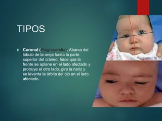 TIPOS
 Coronal (Plagiocefalia). Abarca del
lóbulo de la oreja hasta la parte
superior del cráneo, hace que la
frente se aplane en el lado afectado y
protruya el otro lado, gira la nariz y
se levanta la órbita del ojo en el lado
afectado.
 