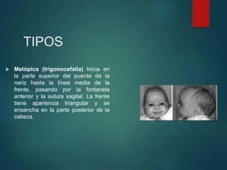 TIPOS
 Metópica (trigonocefalia) Inicia en
la parte superior del puente de la
nariz hasta la línea media de la
frente, pasando por la fontanela
anterior y la sutura sagital. La frente
tiene apariencia triangular y se
ensancha en la parte posterior de la
cabeza.
 