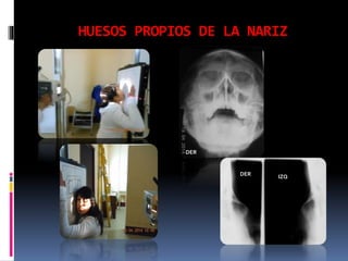 HUESOS PROPIOS DE LA NARIZ
DER
IZQDER
 