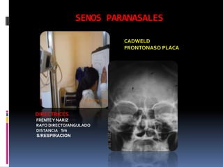 SENOS PARANASALES
CADWELD
FRONTONASO PLACA
DIRECTRICES
FRENTEY NARIZ
RAYO DIRECTO/ANGULADO
DISTANCIA 1m
S/RESPIRACION
 