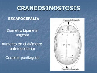 CRANEOSINOSTOSIS
   ESCAFOCEFALIA


  Diametro biparietal
      angosto

Aumento en el diámetro
   anteroposterior

  Occipital puntiagudo
 