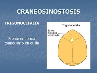 CRANEOSINOSTOSIS
TRIGONOCEFALIA



   Frente en forma
triangular o en quilla
 