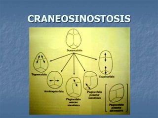CRANEOSINOSTOSIS
 