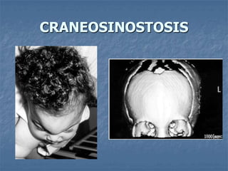 CRANEOSINOSTOSIS
 