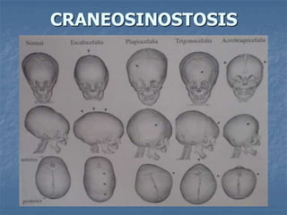 CRANEOSINOSTOSIS
 