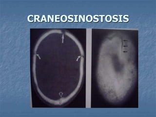 CRANEOSINOSTOSIS
 