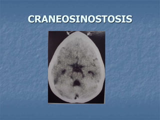 CRANEOSINOSTOSIS
 