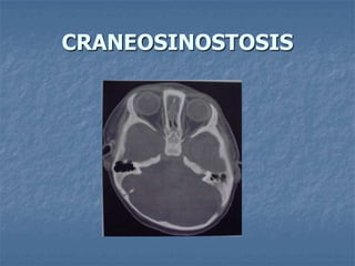 CRANEOSINOSTOSIS
 