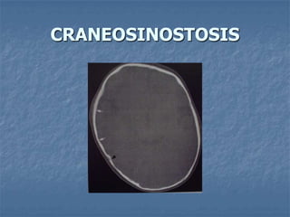 CRANEOSINOSTOSIS
 