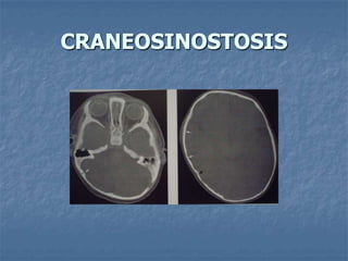 CRANEOSINOSTOSIS
 