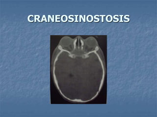 CRANEOSINOSTOSIS
 