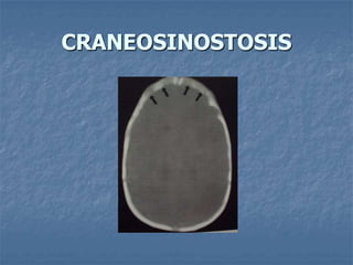 CRANEOSINOSTOSIS
 