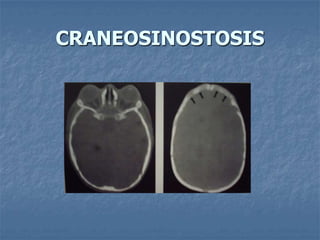 CRANEOSINOSTOSIS
 