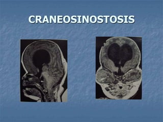 CRANEOSINOSTOSIS
 
