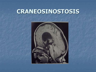 CRANEOSINOSTOSIS
 