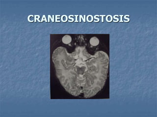CRANEOSINOSTOSIS
 
