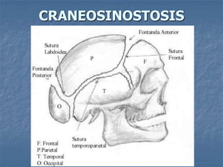CRANEOSINOSTOSIS
 