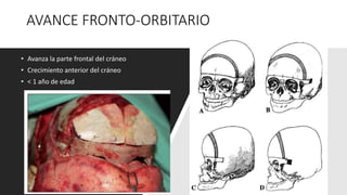 Tratamiento de sinostosis bi coronal
Craniectomia en tira y
avance fronto orbitario
Corrección de
hipertelorismo asociado
...
