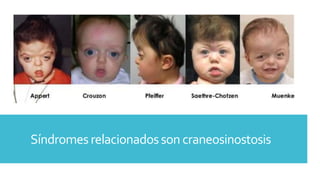 Síndromesrelacionadosson craneosinostosis
 