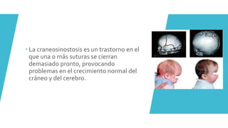  La craneosinostosis es un trastorno en el
que una o más suturas se cierran
demasiado pronto, provocando
problemas en el crecimiento normal del
cráneo y del cerebro.
 