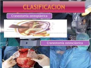 Craneotomía osteoplástica
Craneotomía osteoclástica
 