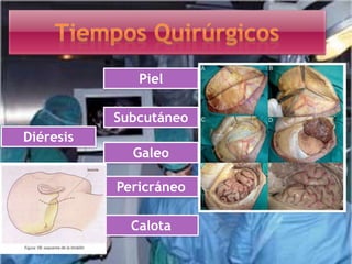 Diéresis
Piel
Subcutáneo
Galeo
Pericráneo
Calota
 