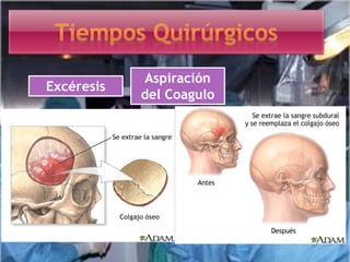 Excéresis
Aspiración
del Coagulo
 