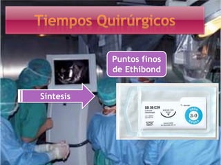 Síntesis
Puntos finos
de Ethibond
 