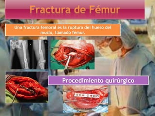 Una fractura femoral es la ruptura del hueso del
muslo, llamado fémur.
Procedimiento quirúrgico
 