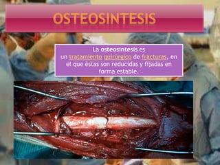 La osteosíntesis es
un tratamiento quirúrgico de fracturas, en
el que éstas son reducidas y fijadas en
forma estable.
 