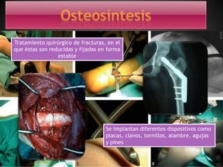 Tratamiento quirúrgico de fracturas, en el
que éstas son reducidas y fijadas en forma
estable
Se implantan diferentes dispositivos como
placas, clavos, tornillos, alambre, agujas
y pines
 