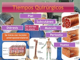Se inicia con incisión
anteroposterolateral
Diéresis Se abordan
los planos
Piel
Subcutáneo
Musculo
Periostio
Hueso
 