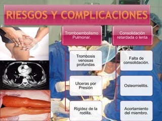 Tromboembolismo
Pulmonar.
Trombosis
venosas
profundas
Ulceras por
Presión
Rigidez de la
rodilla.
Consolidación
retardada o lenta
Falta de
consolidación.
Osteomielitis.
Acortamiento
del miembro.
 