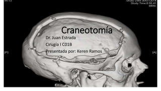 Craneotomía
Dr. Juan Estrada
Cirugía I C01B
Presentada por: Keren Ramos
 