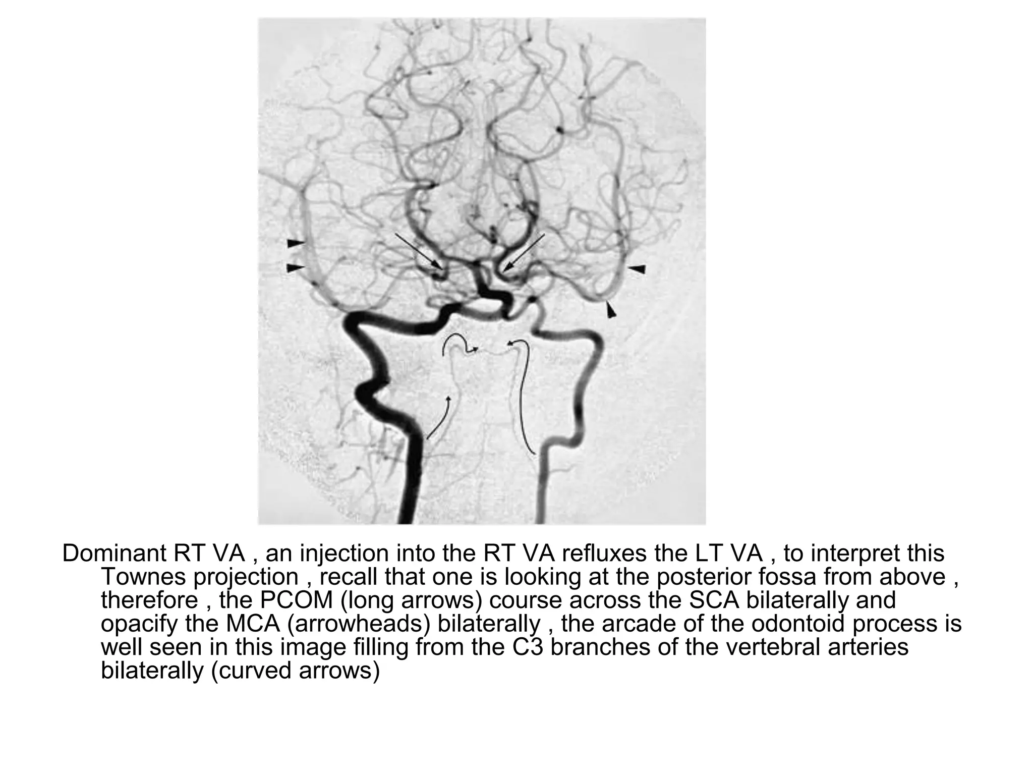 Dominant RT VA , an injection into the RT VA refluxes the LT VA , to interpret this
Townes projection , recall that one is looking at the posterior fossa from above ,
therefore , the PCOM (long arrows) course across the SCA bilaterally and
opacify the MCA (arrowheads) bilaterally , the arcade of the odontoid process is
well seen in this image filling from the C3 branches of the vertebral arteries
bilaterally (curved arrows)
 