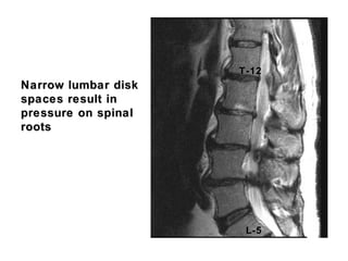 Narrow lumbar diskNarrow lumbar disk
spaces result inspaces result in
pressure on spinalpressure on spinal
rootsroots
L-5
T-12
 