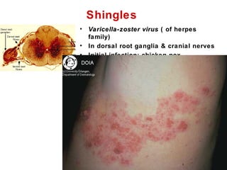 Shingles
• Varicella-zoster virusVaricella-zoster virus ( of herpes
family)
• In dorsal root ganglia & cranial nerves
• Initial infection: chicken pox
 