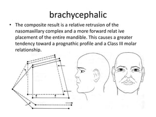 brachycephalic
• The composite result is a relative retrusion of the
nasomaxillary complex and a more forward relat ive
placement of the entire mandible. This causes a greater
tendency toward a prognathic profile and a Class III molar
relationship.
 