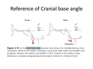 Reference of Cranial base angle
 