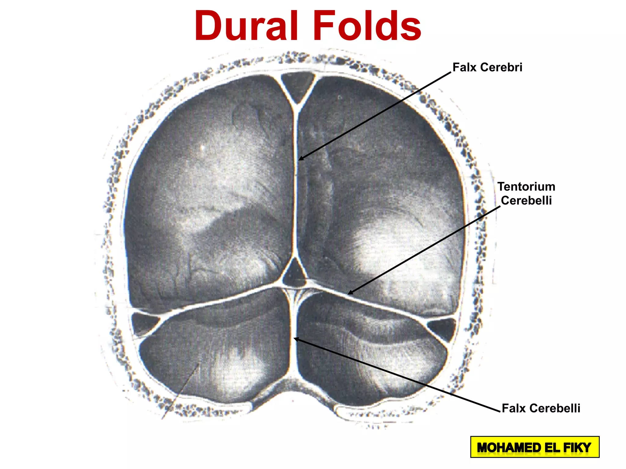 Falx Cerebri
Falx Cerebelli
Tentorium
Cerebelli
Dural Folds
 